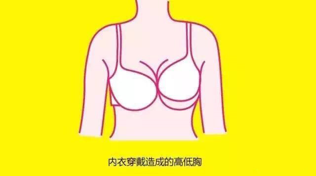 胸部不对称大小胸怎么办?美胸汇怎么样?