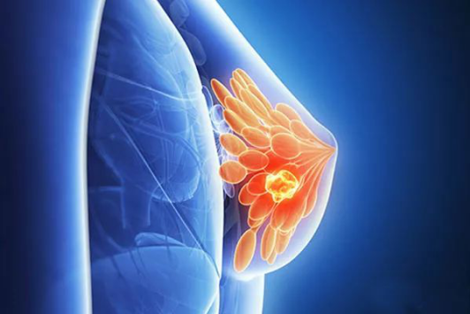 乳腺增生会不会癌变的6大误区