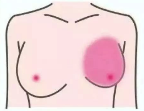 女人胸部为什么会一个大一个小？你不知道的那些事