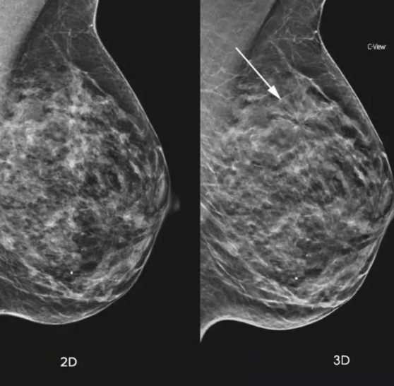 精准检测乳腺癌，3D比2D更优秀