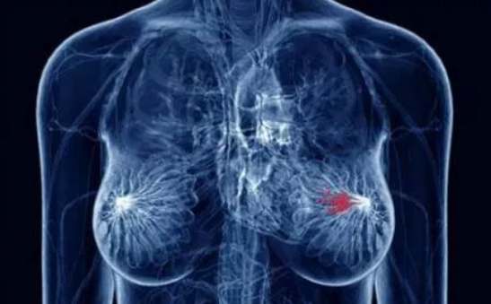 乳腺癌发病前,身体会出现哪些征兆