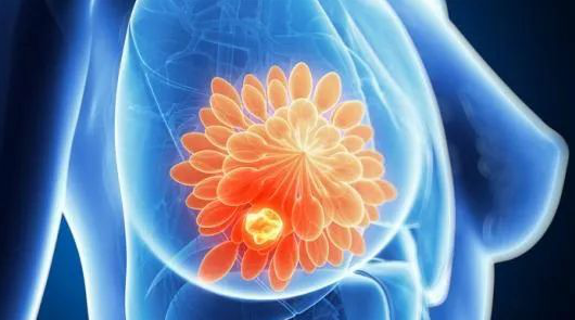 乳腺癌发病前,身体会出现哪些征兆