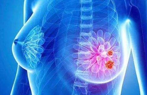 这4种“长相”的乳腺结节，警惕是恶性肿瘤！