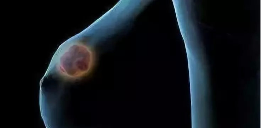 乳腺纤维瘤的早期症状,教你怎样有效去预防!